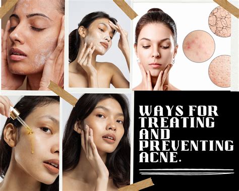 Ways For Treating And Preventing Acne