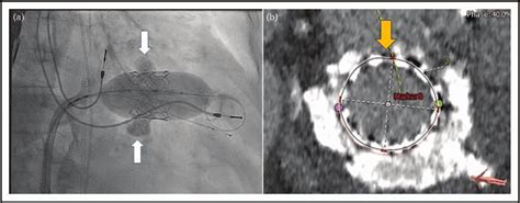 Percutaneous Transcatheter Mitral Valve Replacement Tmvr In Mitral