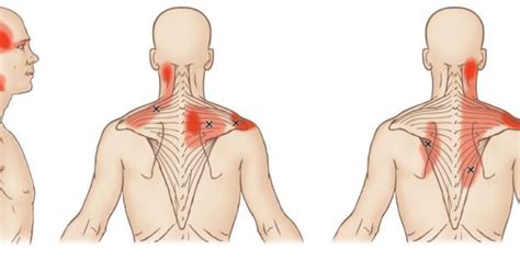 Trapezius Trigger Points — Manual Therapy Courses
