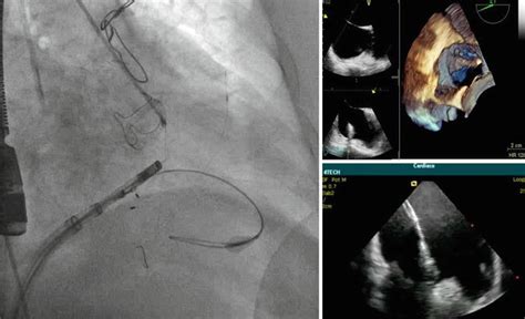 Percutaneous Approaches To Functional Tricuspid Regurgitation