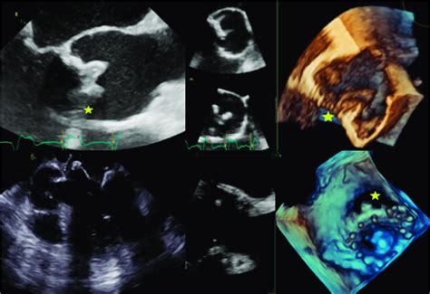 Complications Of Prosthetic Valve Endocarditis Pve Top Biological