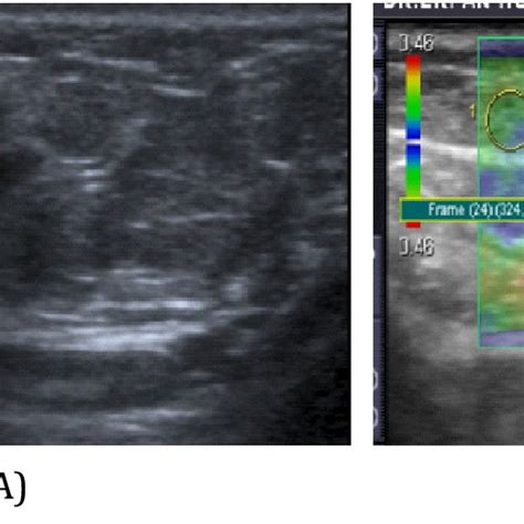 A B Mode Us Image And B Use Image Performed In A Patient With Download Scientific Diagram