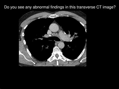 Ppt Image Gallery Lesion Detection On Low Dose Chest Ct Powerpoint Presentation Id