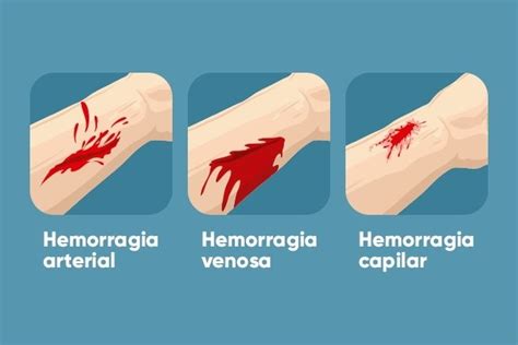 Hemorragia qué es principales tipos y qué hacer Tua Saúde