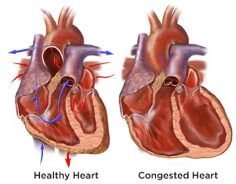 Congestive Heart Failure Causes Stages Treatments And More New