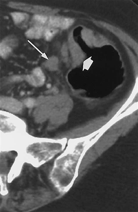 Disproportionate Fat Stranding A Helpful Ct Sign In Patients With
