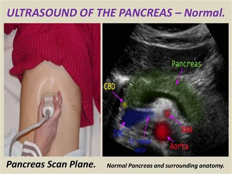 Ultrasound Of Pancrease In Radiology