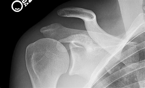 Ac Joint Injury Shoulder Separation — Michael Fu Md Hss Shoulder Surgery