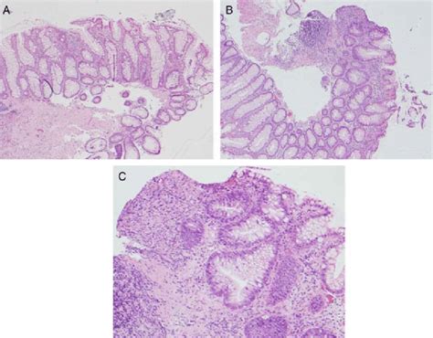 Histopathalogical Specimens Of Rectal Mucosal Biopsies Obtained At