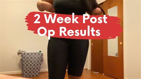2 Week Post Op With Sono Bello Results Youtube