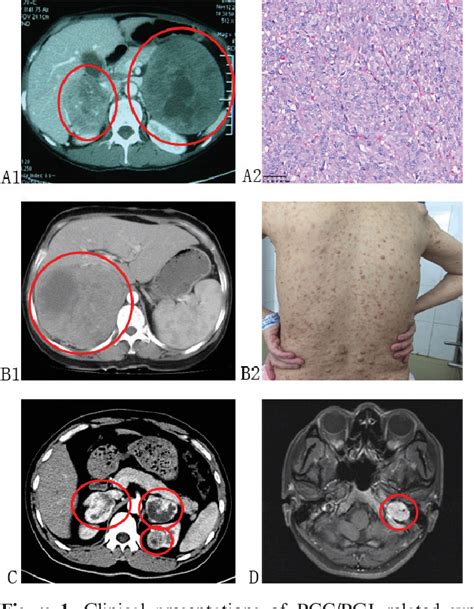 Figure 1 From Clinical Syndromes And Genetic Screening Strategies Of