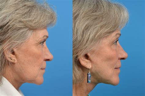 Facelift Photos Melbourne Fl Patient 5010