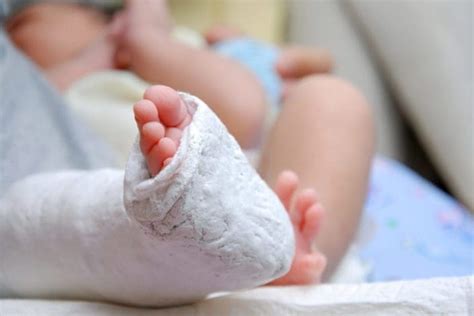 What Is Clubfoot Symptoms And Treatment