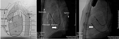 Ll View Of The Heart Left Ll Fluoroscopic Image Showing The Lead Tip