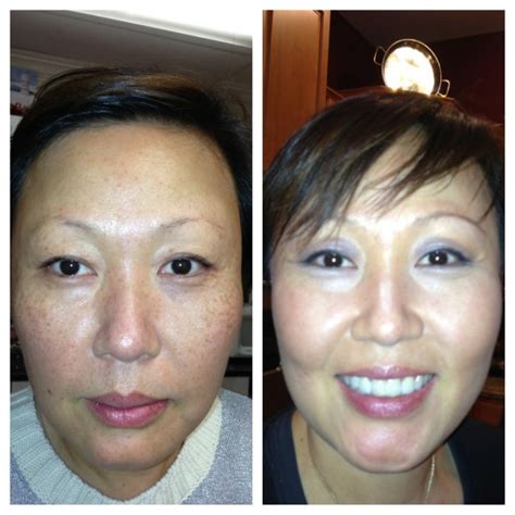 Ipl Before And After Cosmetic Skin Institute Skin Care
