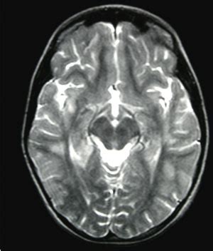 Encephalomyelitis is inflammation of the brain and spinal cord. Encefalomielitis aguda diseminada: Reporte de un caso y revisión de la literatura