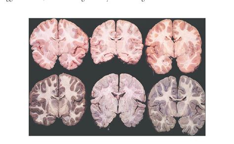 Photograph Of 6 Formalin Fixed Brain Slices From 6 Different Autopsy
