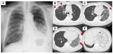 Cureus Idiopathic Pulmonary Fibrosis Complicated By Adenocarcinoma