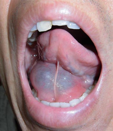 The Oral Floor At The First Visit Right Sublingual Bluish Swelling