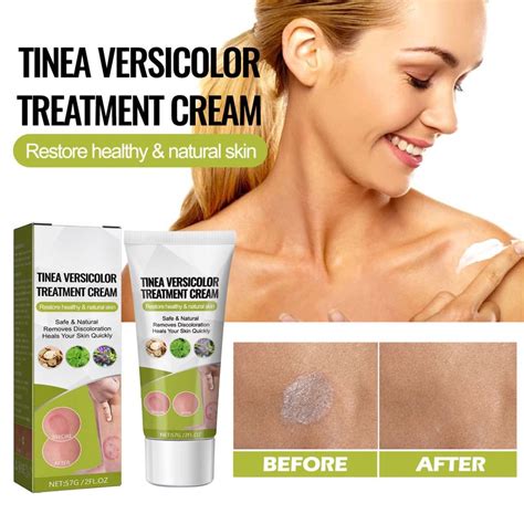 57g Tinea Versicolor Treatment Antifungal Cream For Tinea Versicolor
