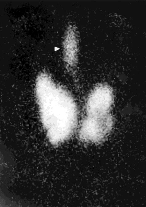 Technetium 99m Thyroid Scan Shows A Multinodular Download Scientific