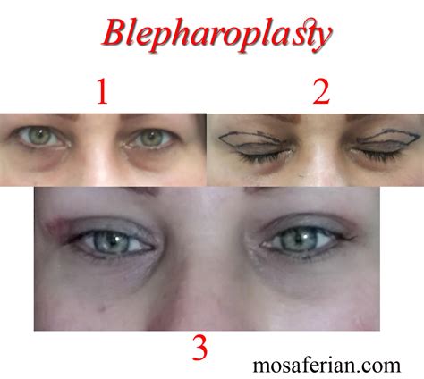 How Long Does Double Eyelid Surgery Take To Heal Cheaper Than Retail Price Buy Clothing
