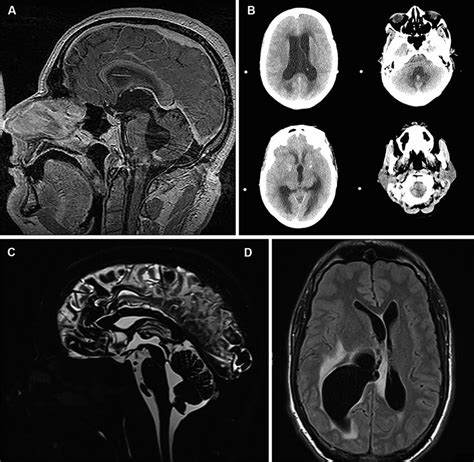 Obstructive Hydrocephalus In Neurosarcoidosis Mid Sagittal Contrast