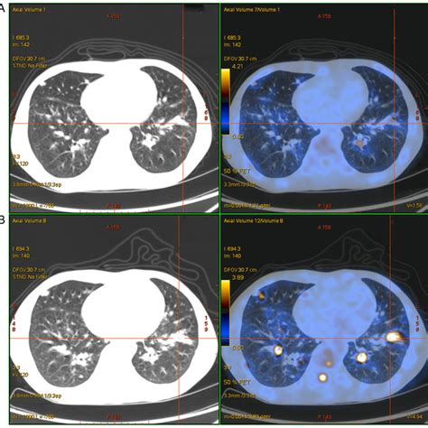 18 F Fdg Pet Ct Scans Of The Whole Body Of The Patient Showing
