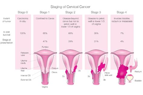 Different Stages Of Vaginal Cancer Lady Care Health