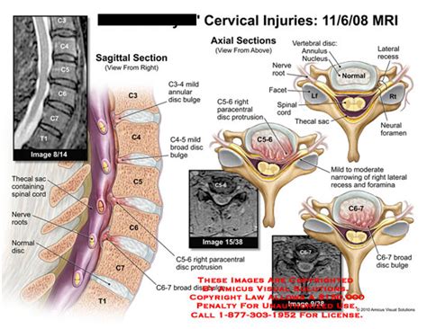 Amicus Illustration Of Amicus Injury Cervical Mri C3 4 Annular Disc