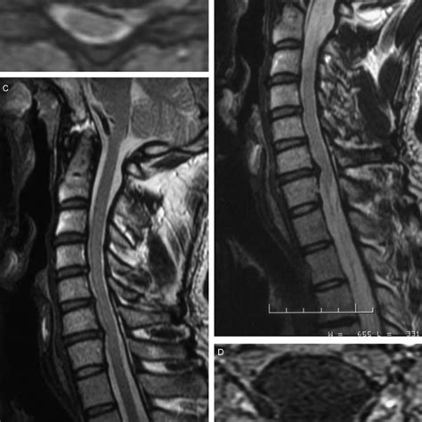 A T 1 Weighted Cervical Axial Mri Showing Soft Disc Herniation On The