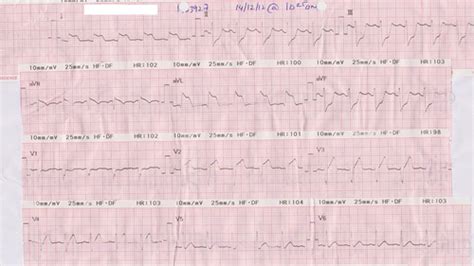 Hospital sultanah aminah blood bank. TCTAP C-015 Rescue Percutaneous Coronary Intervention to ...