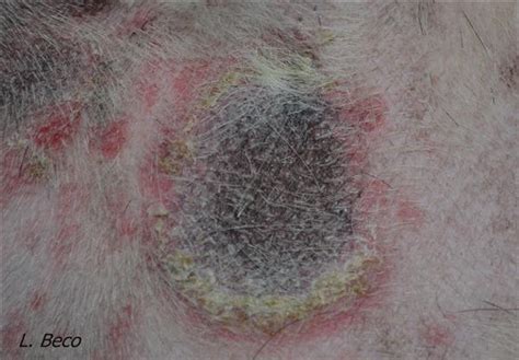 Infections De La Peau Dermatoses Infectieuses Infections Cutanees