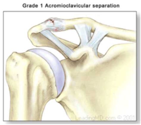 Ac Joint Separation Separated Shoulder Vail Aspen Denver Co