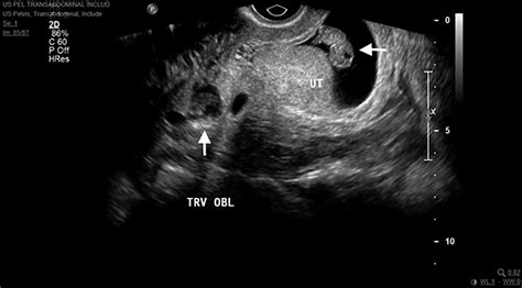 Evaluation And Management Of Ectopic Pregnancy In The Emergency