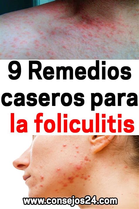 9 Remedios Caseros Para La Foliculitis Skin Tips Movie Posters