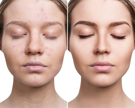 All About Acne Types Causes Signs Symptoms Treatment Kulturaupice