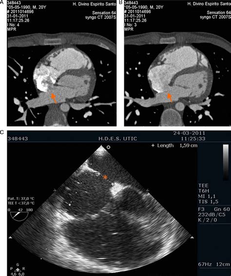 Ostium Secundum Type Atrial Septal Defect A And B Cardiac Ct C