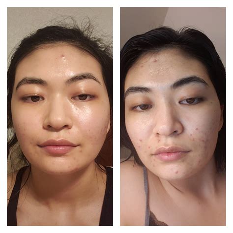 Tretinoin Before After Before And After Month 2 On 05 Tretinoin Cream