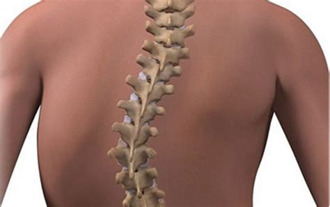 Scoliosis Symptoms And Conditions Upper Cervical Awareness