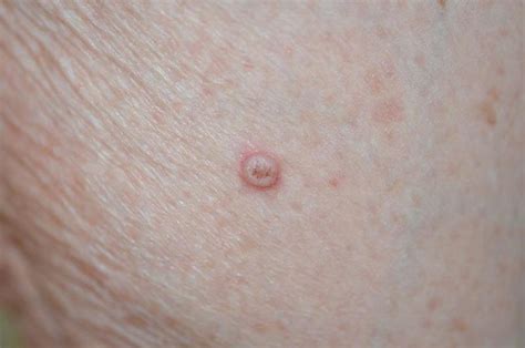 Papilloma And Scc Multikinase Inhibitor Skin Toxicity Oncologypro