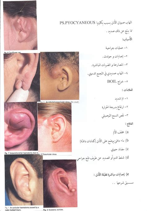 المدونة الطبية دفهيد سالم السبيعي امراض الاذن الخارجية External Ear