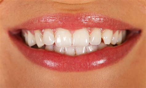 How To Get Rid Of White Spots On Teeth Gables Sedation