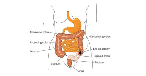 Colostomy Procedure Steps