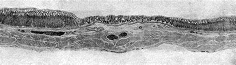 Зарубцевавшаяся язва диета Атлас рисунков 351-400 [1938 Давыдовский И.В. - Паталогическая анатомия Атлас рисунков 351-400 [1938 Давыдовский И.В. - Паталогическая анатомия Зарубцевавшаяся язва диета