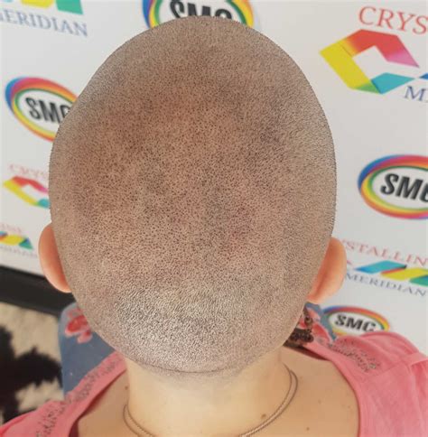 When you have diffuse hair loss, the hair density on the entire head decreases. Scalp Micropigmentation Diffuse Thinning Treatments - What ...