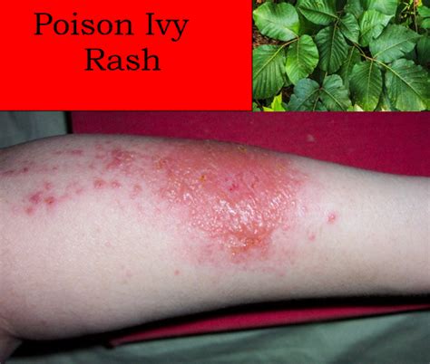 Common Acute Rashes In Urgent Care Setting Medical Care 1