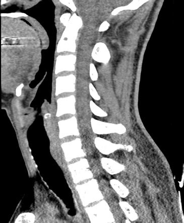 Normal Cervical Spine CT Radiology Case Radiopaedia Org