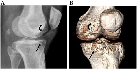 Femoral Condyle Insufficiency Fracture