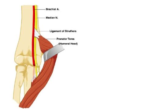 Pronator Syndrome Hand Orthobullets